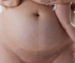 Load image into Gallery viewer, Silicone Gel Scar Strips